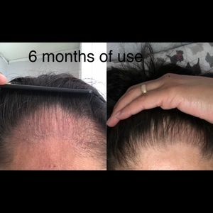 Voce Crescer Accessories Vc Hair Loss Treatment Shampoo 1 Month